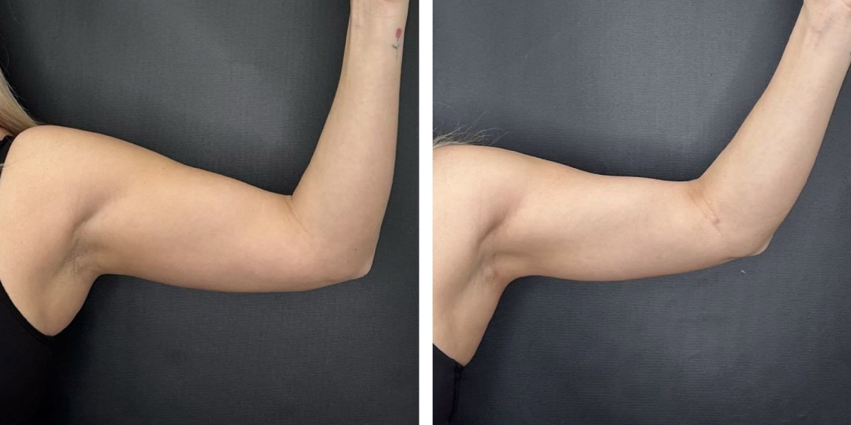 before and after arm liposuction left arm front view female patient case 1649