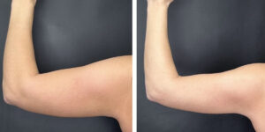 before and after arm liposuction left arm back view female patient case 1649
