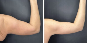 before and after arm liposuction right arm back view female patient case 1649