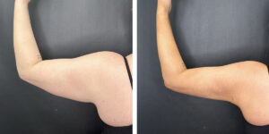before and after arm liposuction left arm back view female patient case 1654