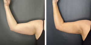 before and after arm liposuction right arm front view female patient case 1654