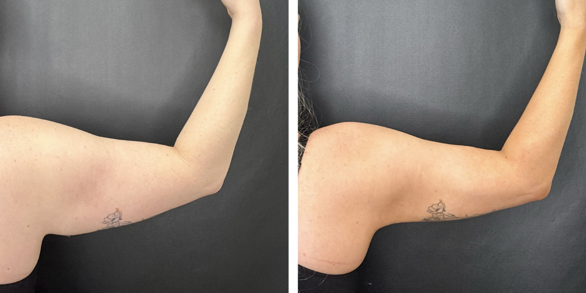 before and after arm liposuction right arm back view female patient case 1654