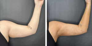 before and after arm liposuction left arm front view female patient case 1654