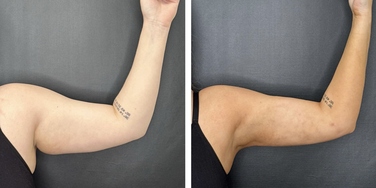 before and after arm liposuction left arm front view female patient case 1654