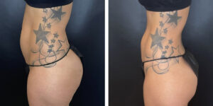 before and after liposuction left side view female patient case 1659