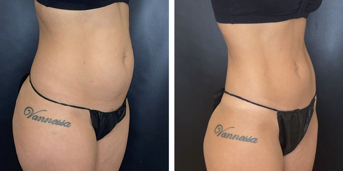 before and after liposuction right angled view female patient case 1659