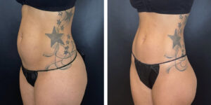 before and after liposuction left angled view female patient case 1659