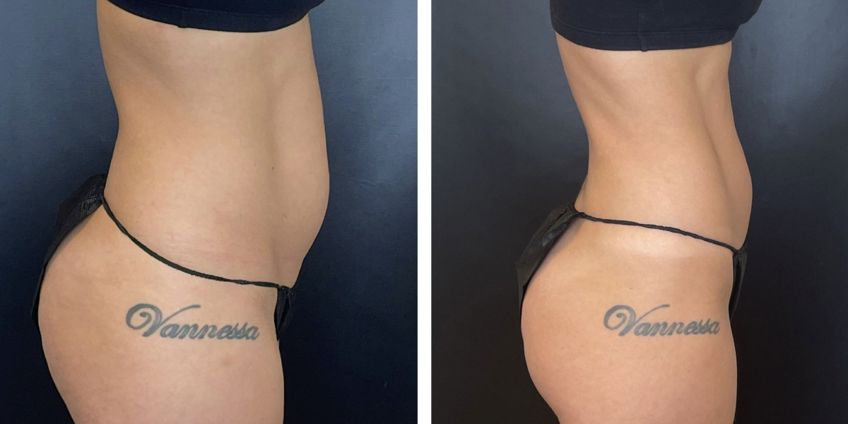 before and after liposuction right side view female patient case 1659