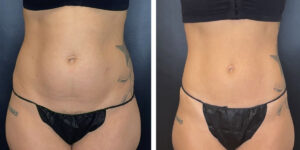 before and after liposuction front view female patient case 1659