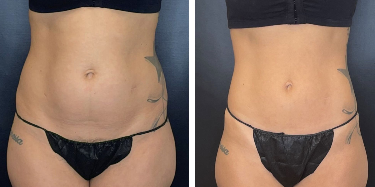 before and after liposuction front view female patient case 1659