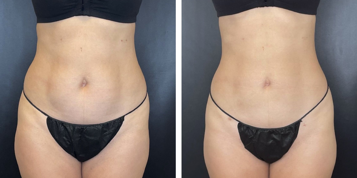 before and after liposuction front view female patient case 1665