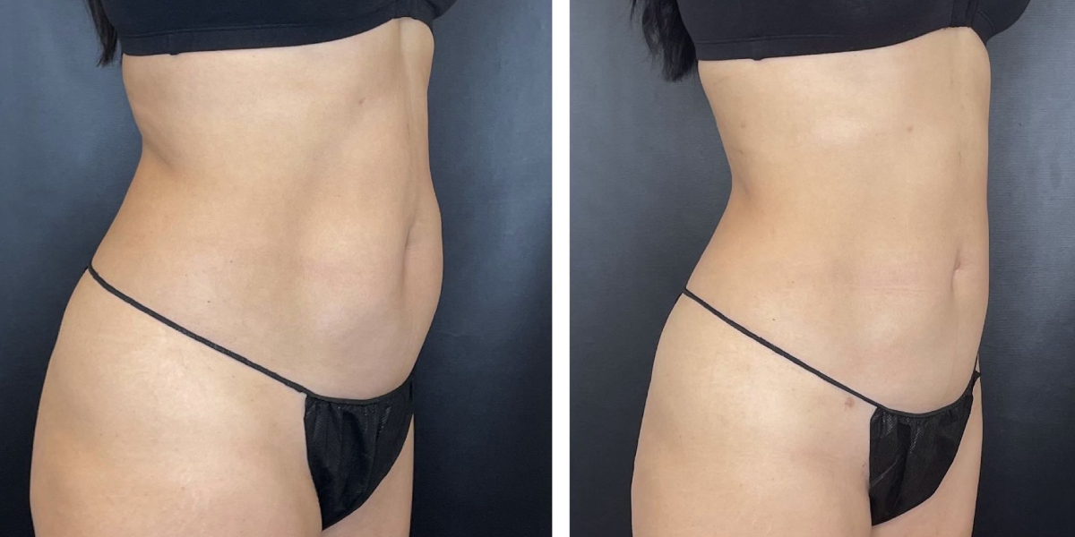 before and after liposuction right angled view female patient case 1665