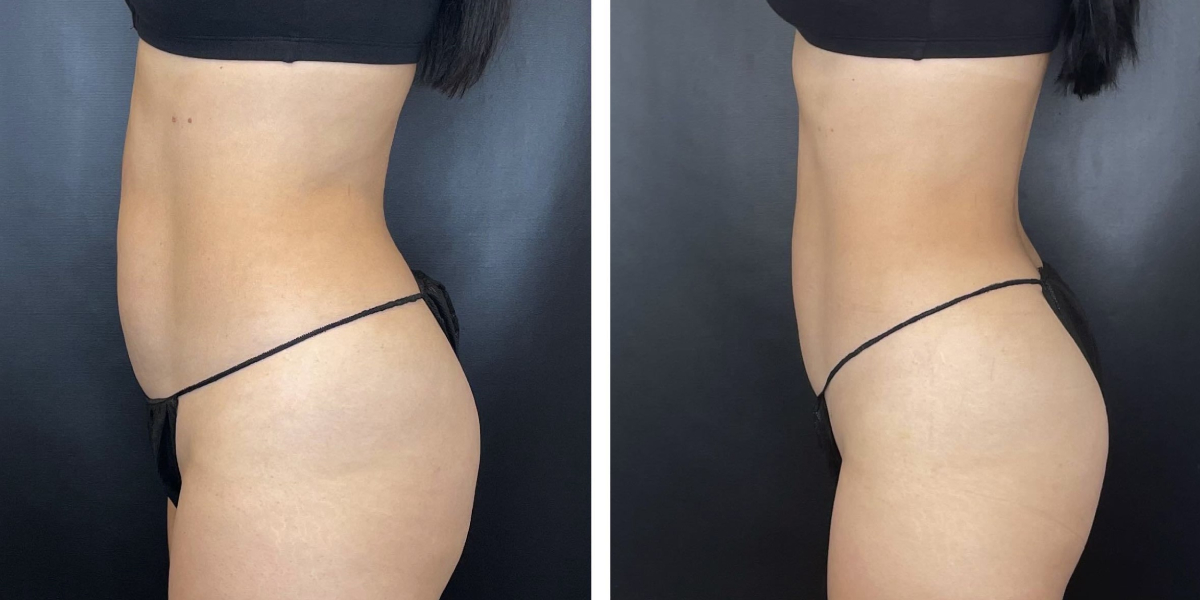 before and after liposuction left side view female patient case 1665