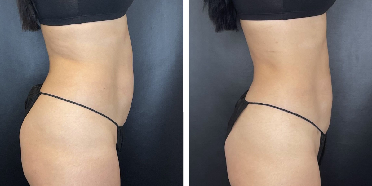 before and after liposuction right side view female patient case 1665