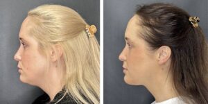before and after facial liposuction female patient left side view case 1742