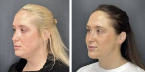 before and after facial liposuction female patient left angle view case 1742