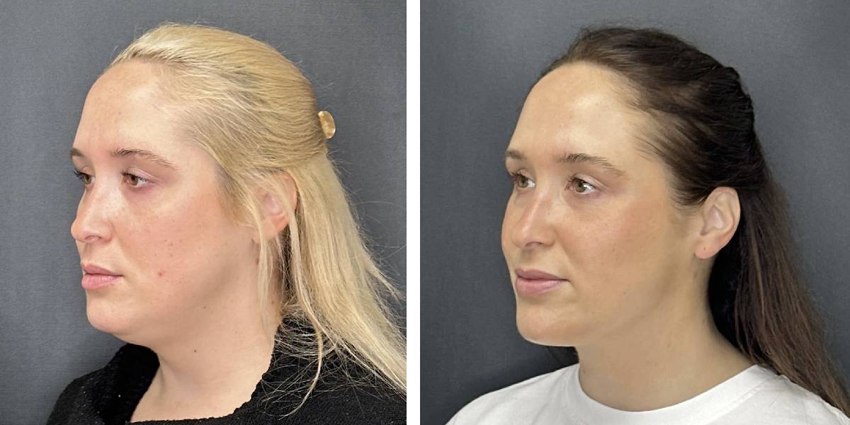 before and after facial liposuction female patient left angle view case 1742