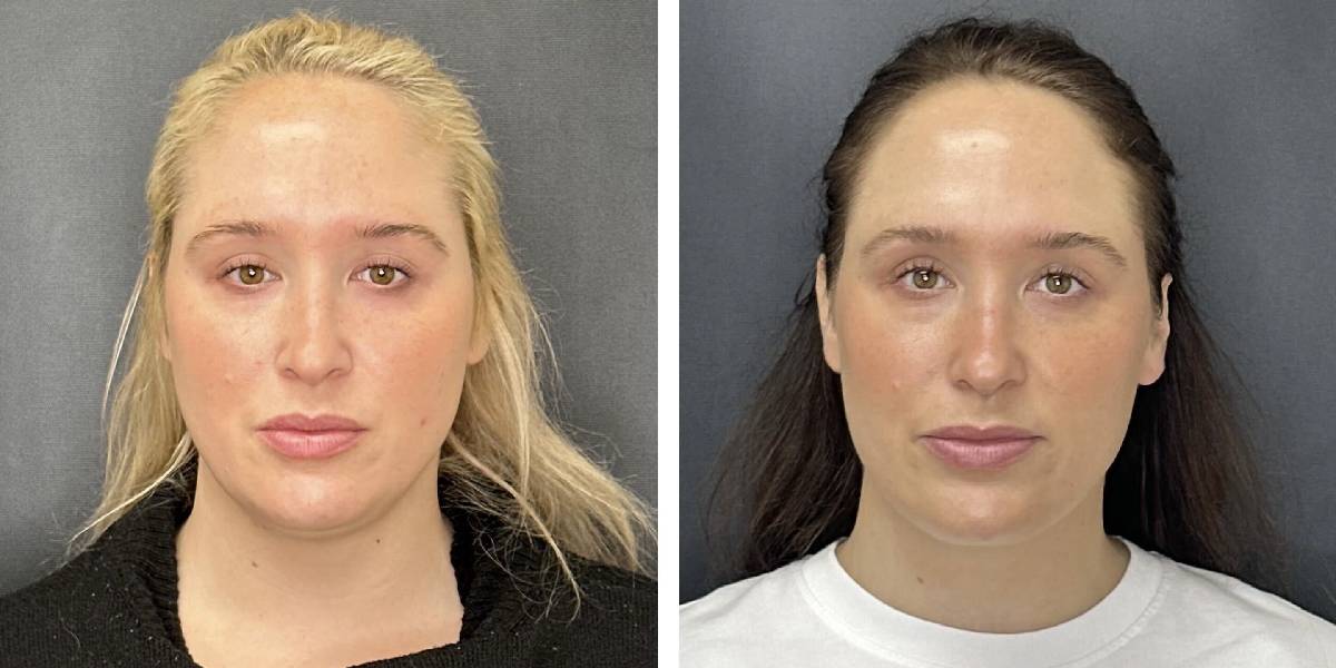 before and after facial liposuction female patient front view case 1742