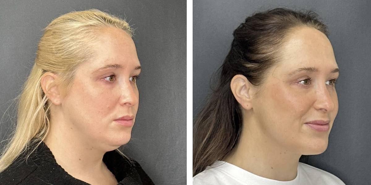 before and after facial liposuction female patient right angle view case 1742