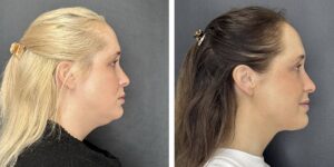 before and after facial liposuction female patient right side view case 1742