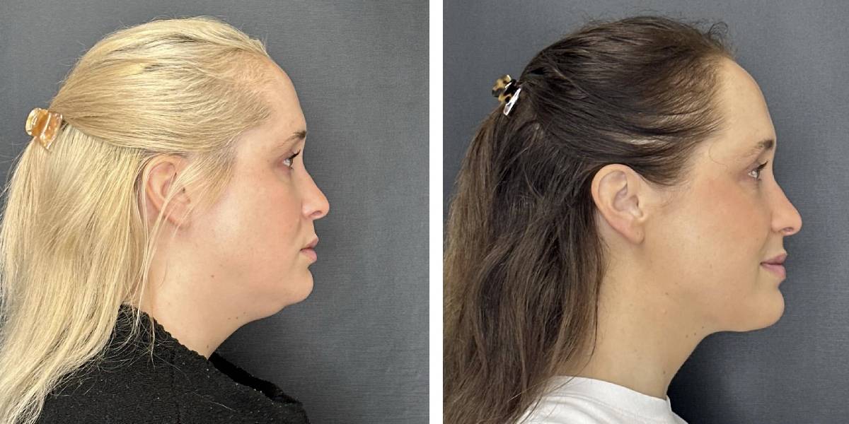 before and after facial liposuction female patient right side view case 1742