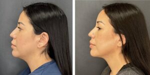 before and after facial liposuction female patient left side view case 1748