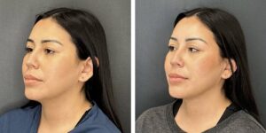 before and after facial liposuction female patient left angle view case 1748