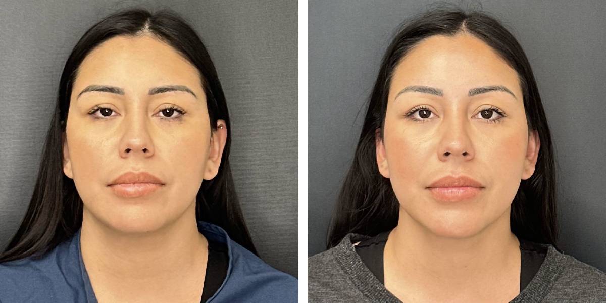 before and after facial liposuction female patient front view case 1748