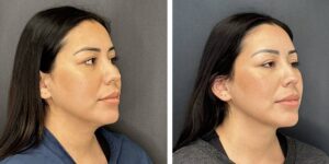 before and after facial liposuction female patient right angle view case 1748