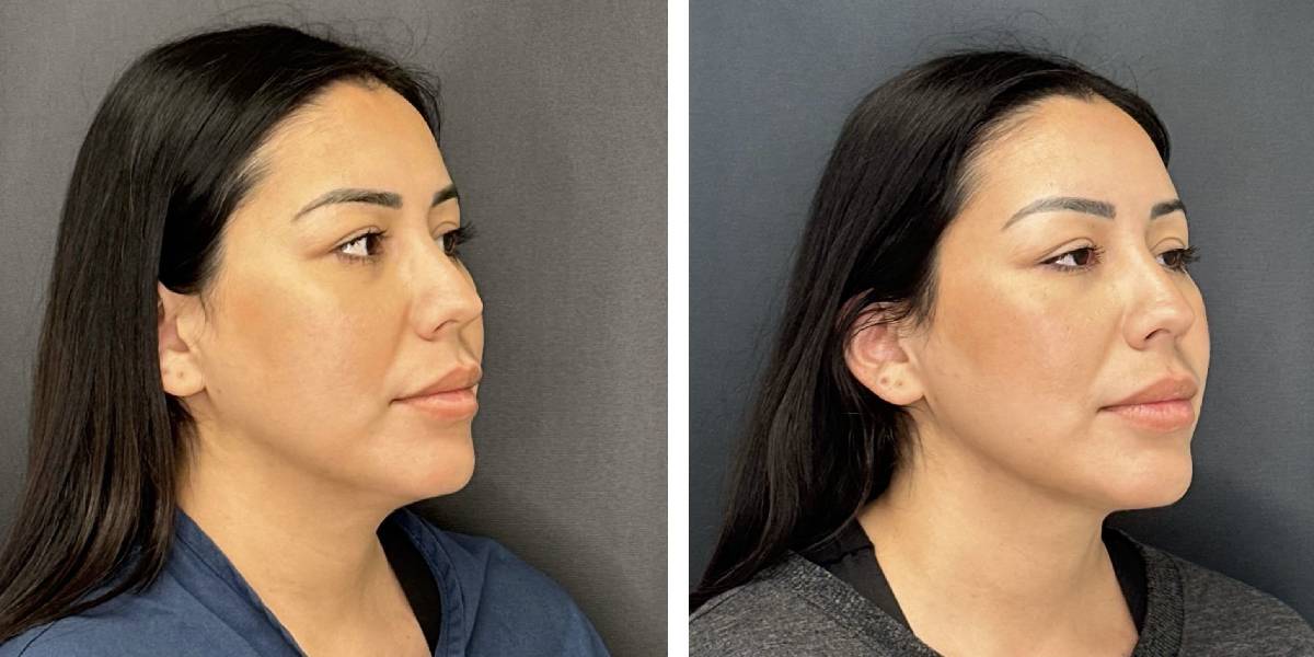 before and after facial liposuction female patient right angle view case 1748