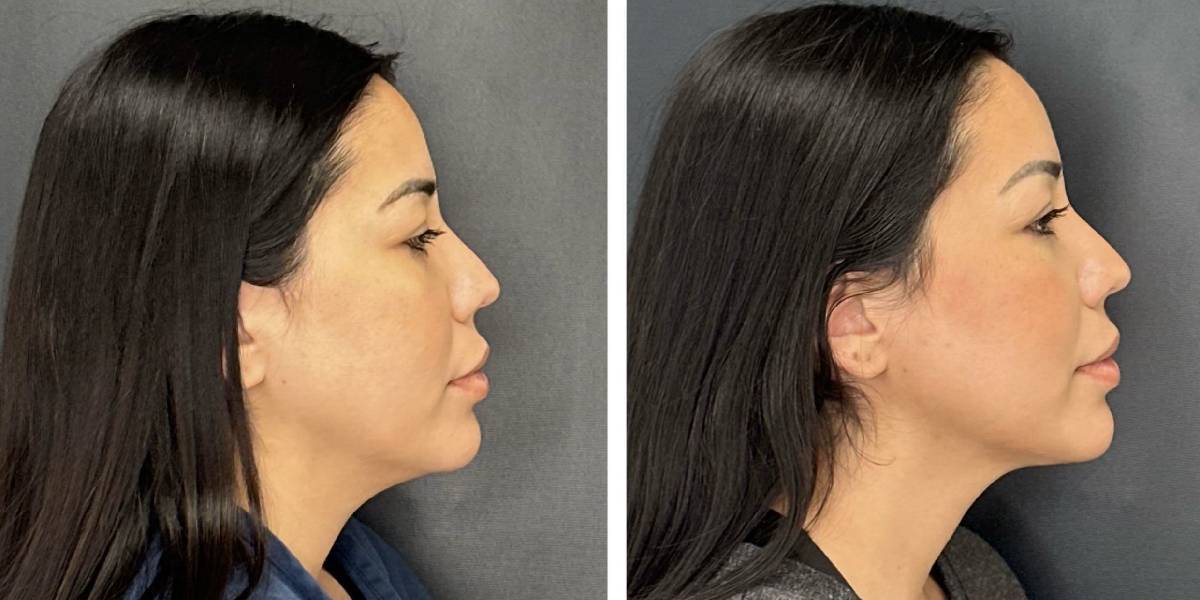 before and after facial liposuction female patient right side view case 1748
