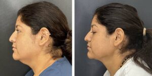 before and after facial liposuction female patient left side view case 1755
