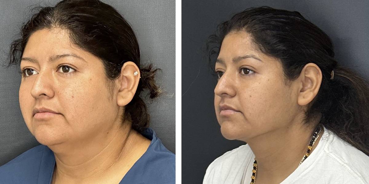 before and after facial liposuction female patient left angle view case 1755