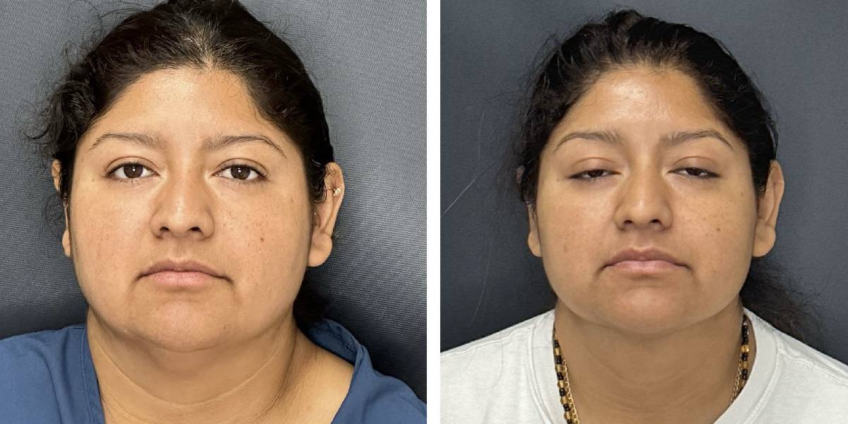 before and after facial liposuction female patient front view case 1755