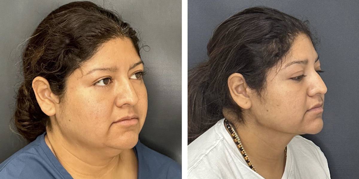 before and after facial liposuction female patient right angle view case 1755