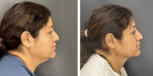 before and after facial liposuction female patient right side view case 1755