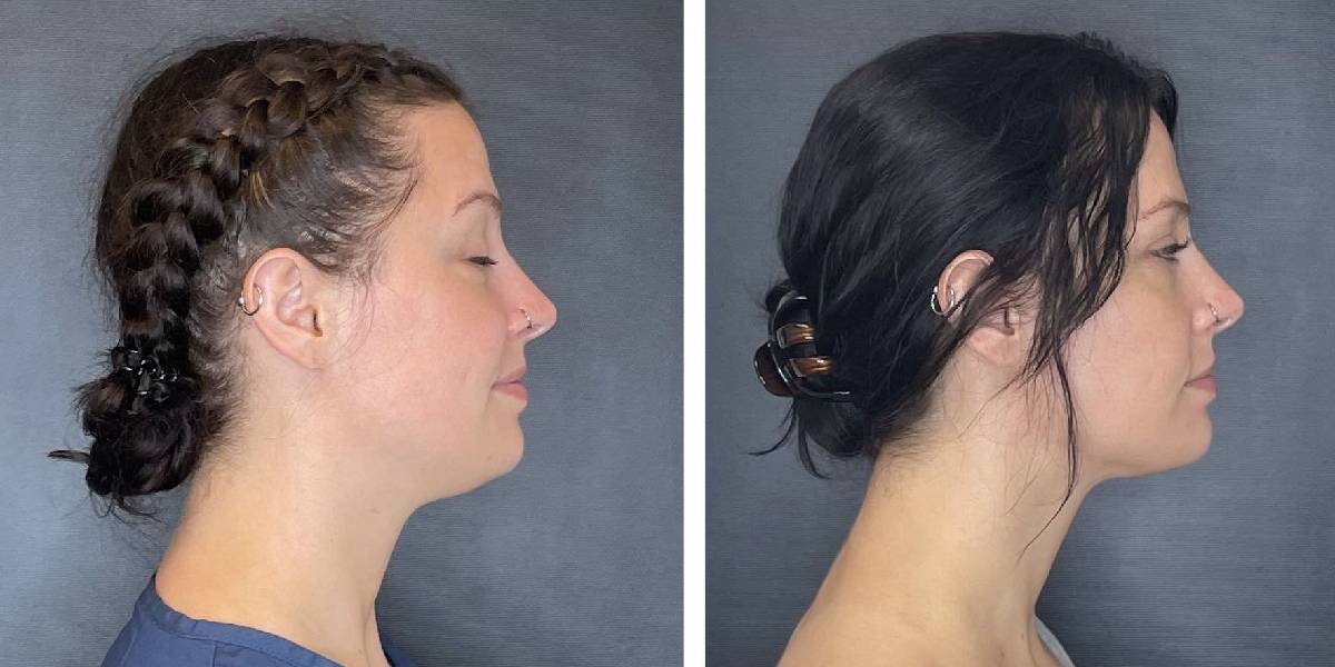 before and after facial liposuction female patient right side view case 1761