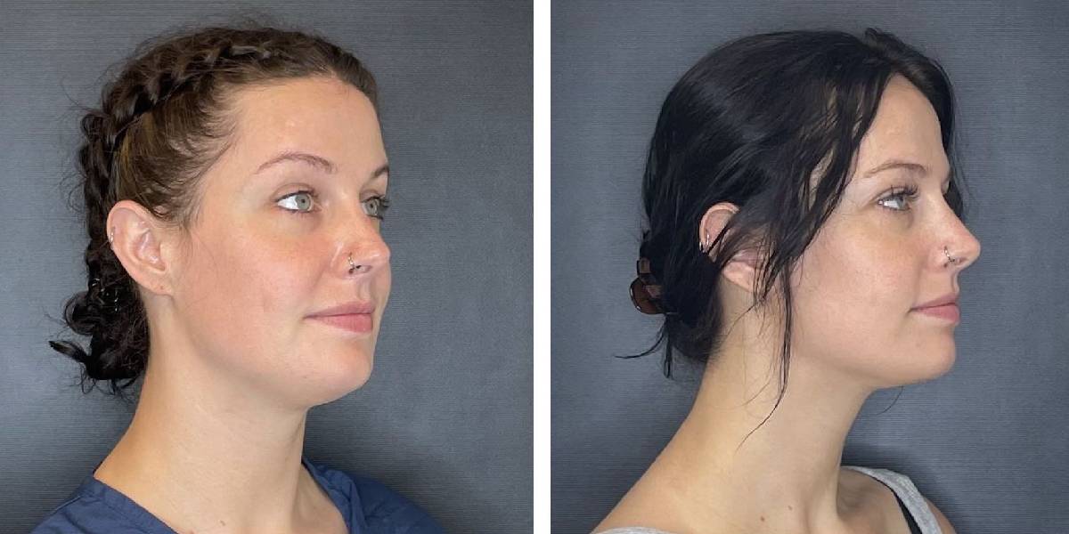 before and after facial liposuction female patient right angle view case 1761