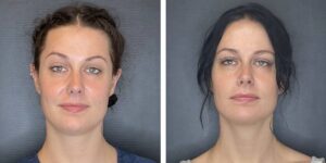 before and after facial liposuction female patient front view case 1761