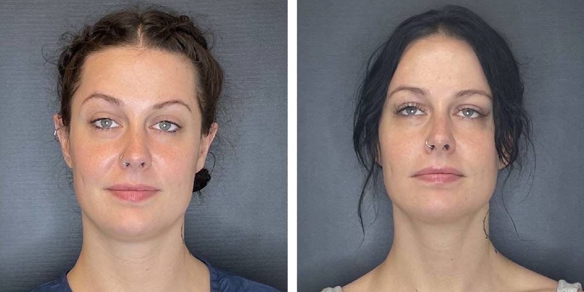 before and after facial liposuction female patient front view case 1761