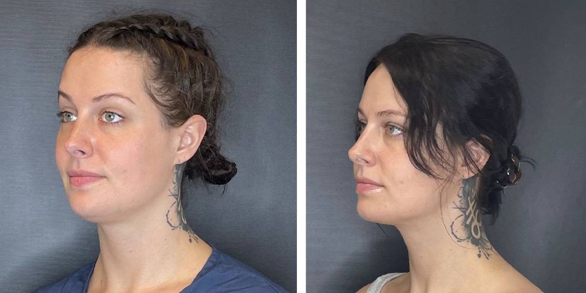 before and after facial liposuction female patient left angle view case 1761