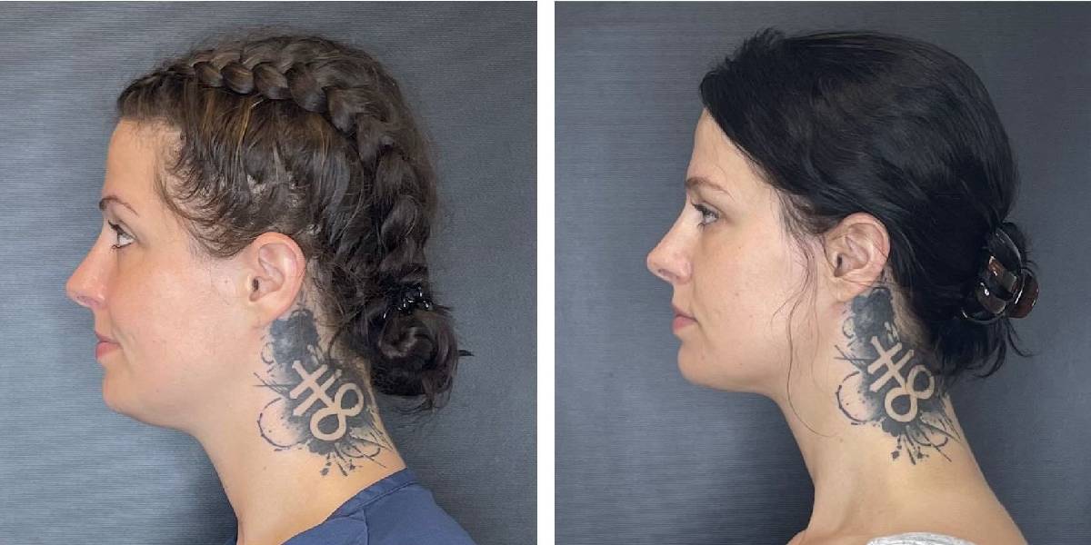 before and after facial liposuction female patient left side view case 1761