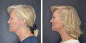 before and after facial liposuction female patient left side view case 1768