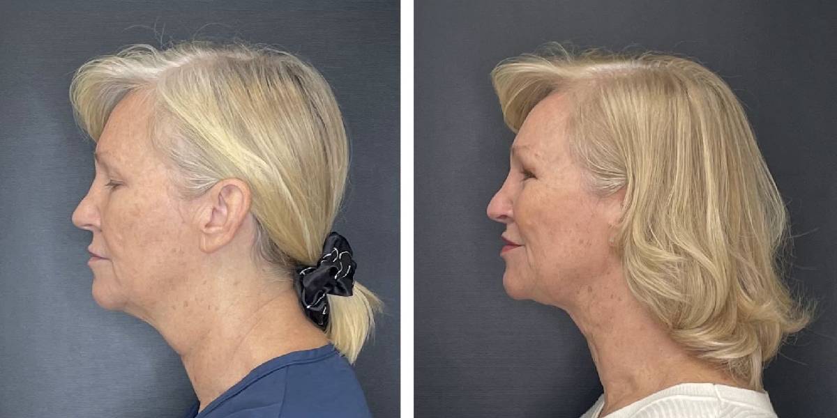 before and after facial liposuction female patient left side view case 1768