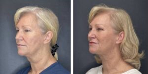 before and after facial liposuction female patient left angled view case 1768