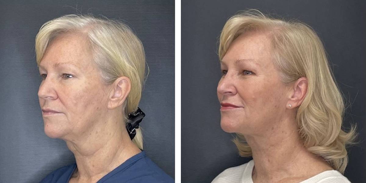 before and after facial liposuction female patient left angled view case 1768