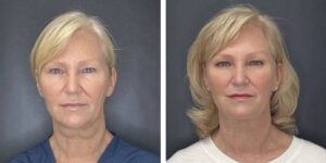 before and after facial liposuction female patient front view case 1768