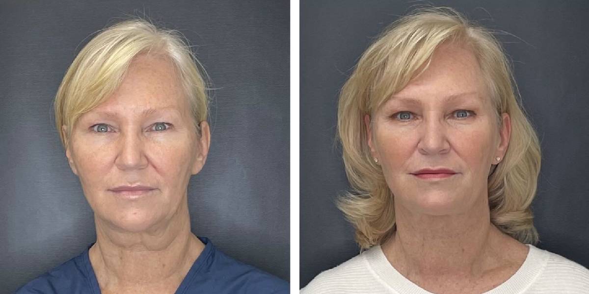 before and after facial liposuction female patient front view case 1768