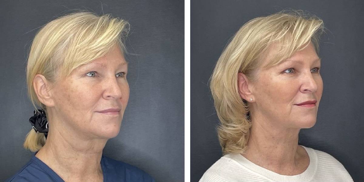 before and after facial liposuction female patient right angled view case 1768