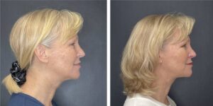 before and after facial liposuction female patient right side view case 1768